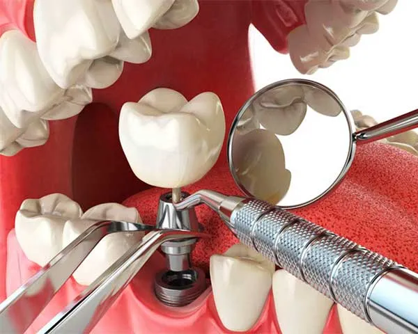 Implantes dentales de alta calidad