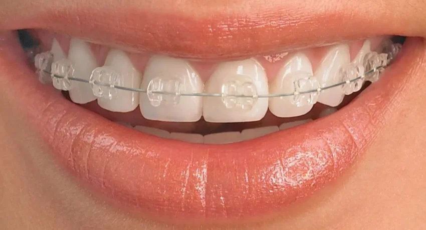 brackets-esteticos-1