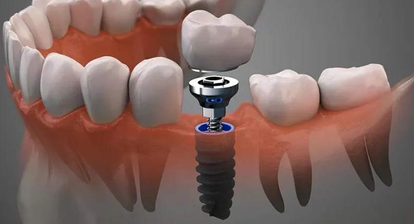 implantologia-3d